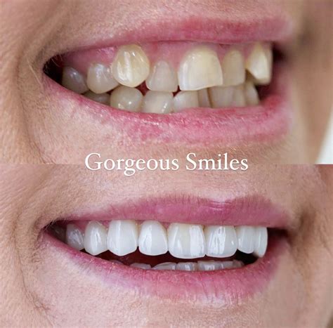 invisalign results after 1 month|invisalign snaggletooth before and after.
